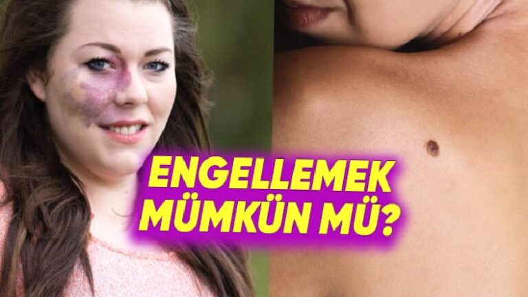 Çilek ve Şarap Lekesi Doğum Lekeleri Neden Oluşuyor? Aslında Önlenebilir mi?