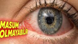 Gece Dayak Yemiş gibi: Sabah Uyandığımızda Gözlerimiz Neden Kan Çanağı gibi Oluyor?