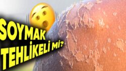 Güneşte Yandıktan Sonra Cildimiz Neden Soyuluyor? Deriyi Kendimizin Kaldırması Tehlikeli Bir Hareket mi?