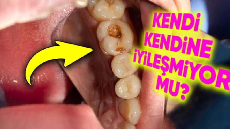 Bedenimizin Herhangi Bir Yeri Kendi Kendini İyileştirebiliyorken Dişlerimiz İçin Neden Bir Müdahale Gerekiyor?