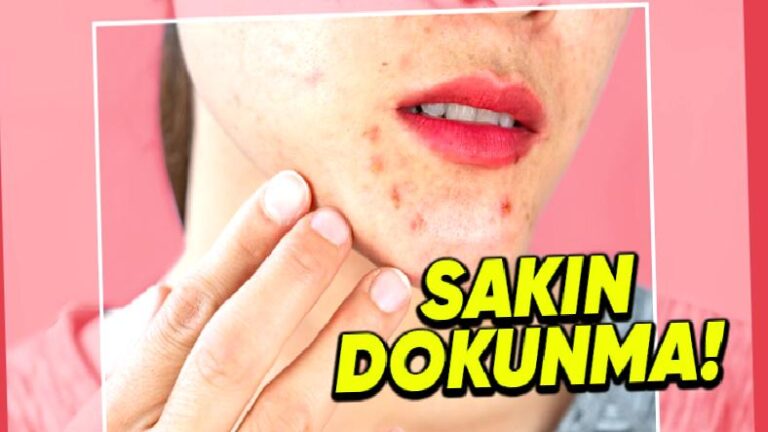 Sivilcelerinizi Patlatınca Cildinizde Neler Olduğunu Öğrenince Onlara Bir Daha Dokunmak İstemeyeceksiniz!