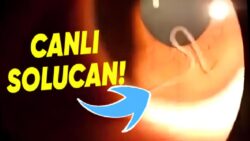 Bir Bayanın Sağ Göz Kapağında Büyüyüp Gelişen Bu Canlı Solucanlar Aslında Neyin Nesi?