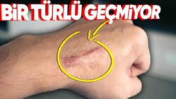 Bedenimizdeki Düz Yaralar Dalgalı Yaralara Göre Neden Çok Daha Geç Güzelleşiyor?