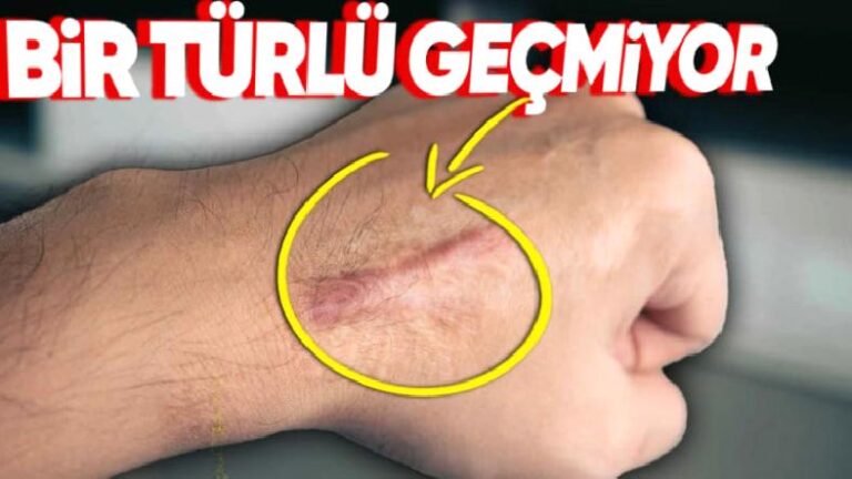 Bedenimizdeki Düz Yaralar Dalgalı Yaralara Göre Neden Çok Daha Geç Güzelleşiyor?