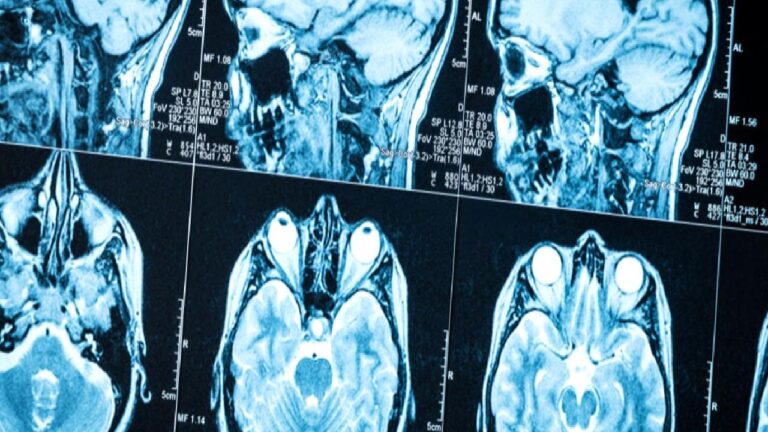 Beyin tümörlerinde erken teşhis için yeni umut: Yapay zeka