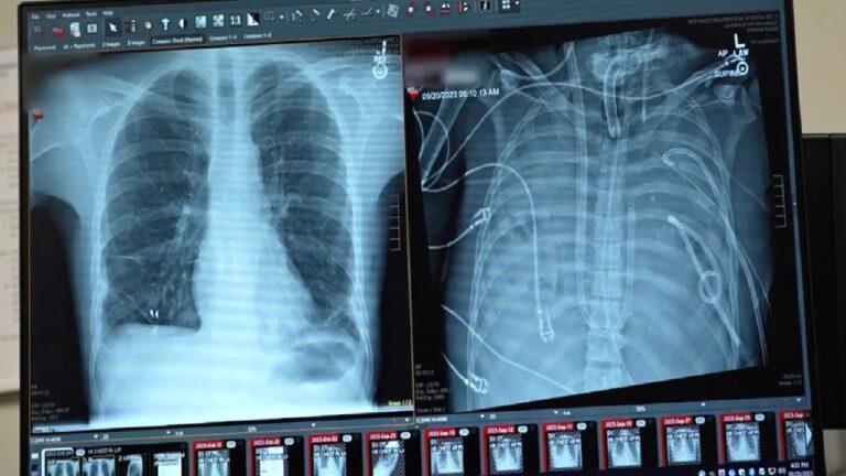 Tıpta tarihi an: Bir hasta, akciğerleri olmadan 2 gün yaşadı!