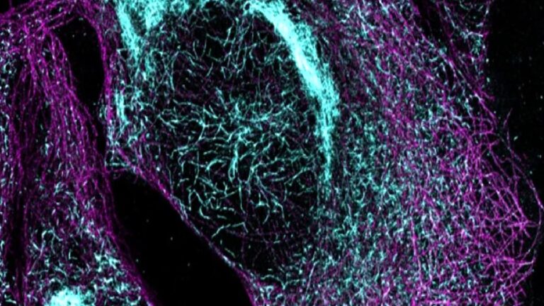 Basit bir kan testi Alzheimer’in hangi aşamada olduğunu gösterebiliyor