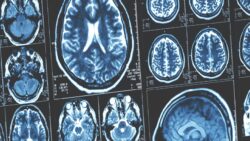 Alzheimer için dikkat çeken bulgu: Her şey beyinle ilgili değil!