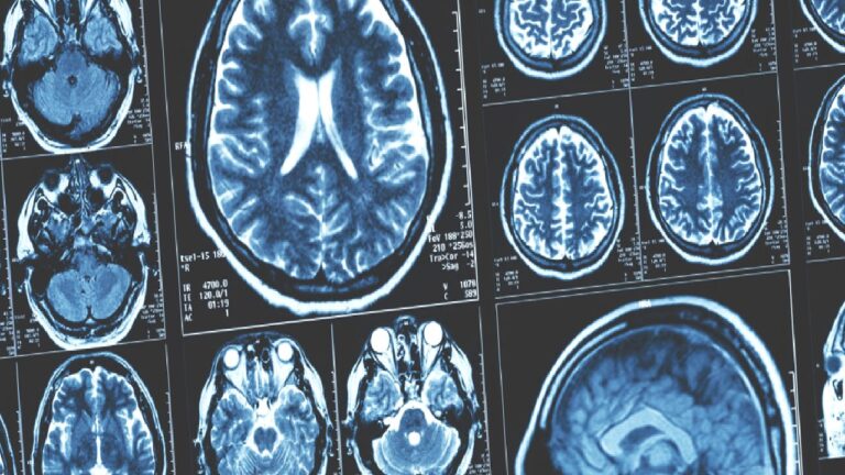 Alzheimer için dikkat çeken bulgu: Her şey beyinle ilgili değil!